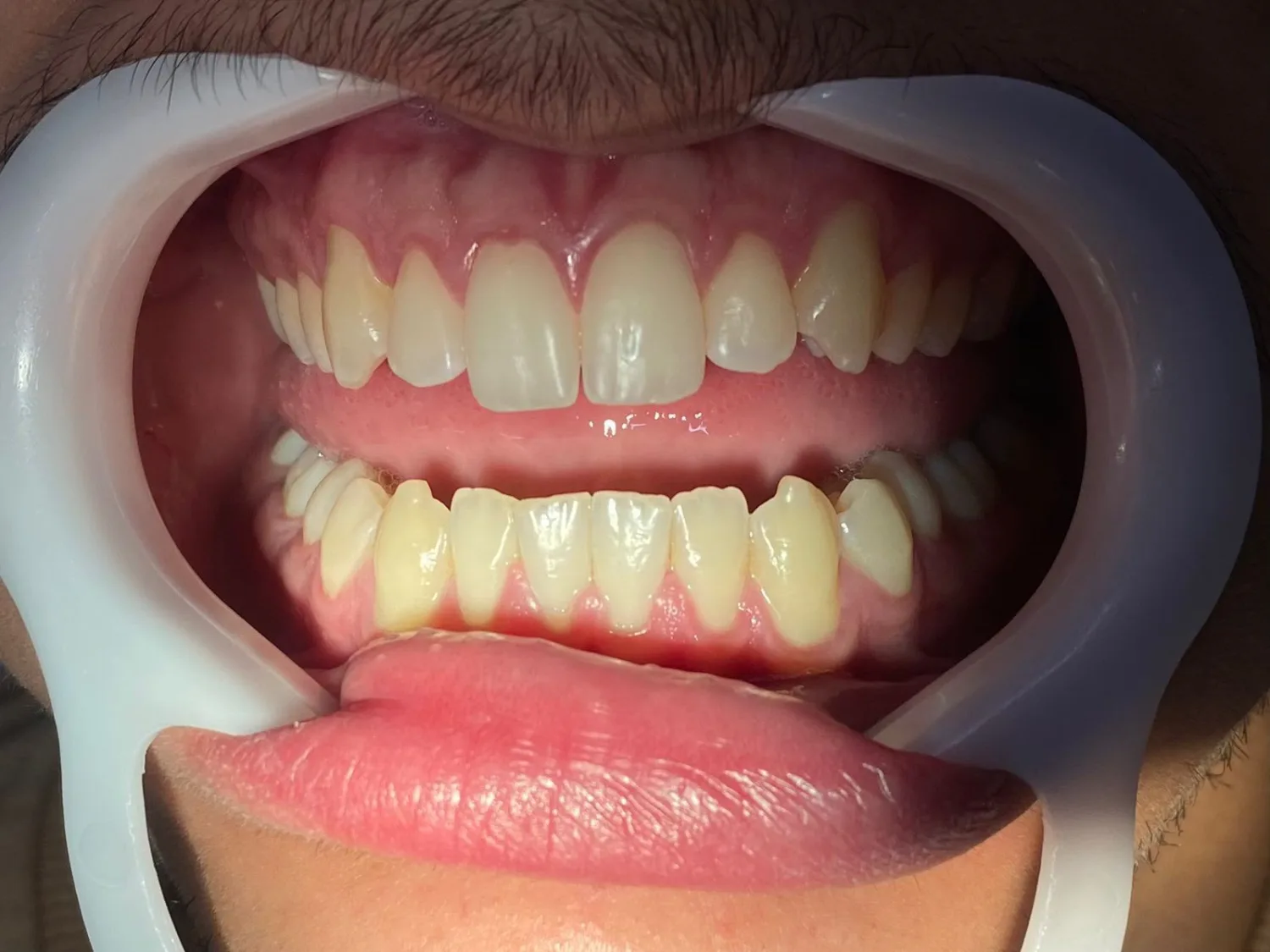 Registro intraoral para acompanhamento de clareamento dental