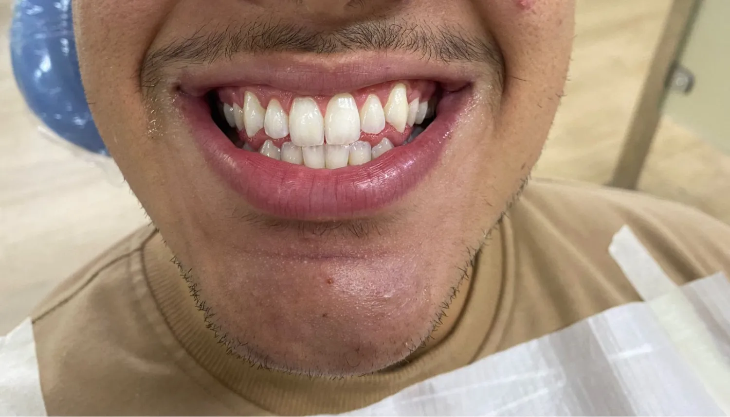 Registro do sorriso em acompanhamento de clareamento dental