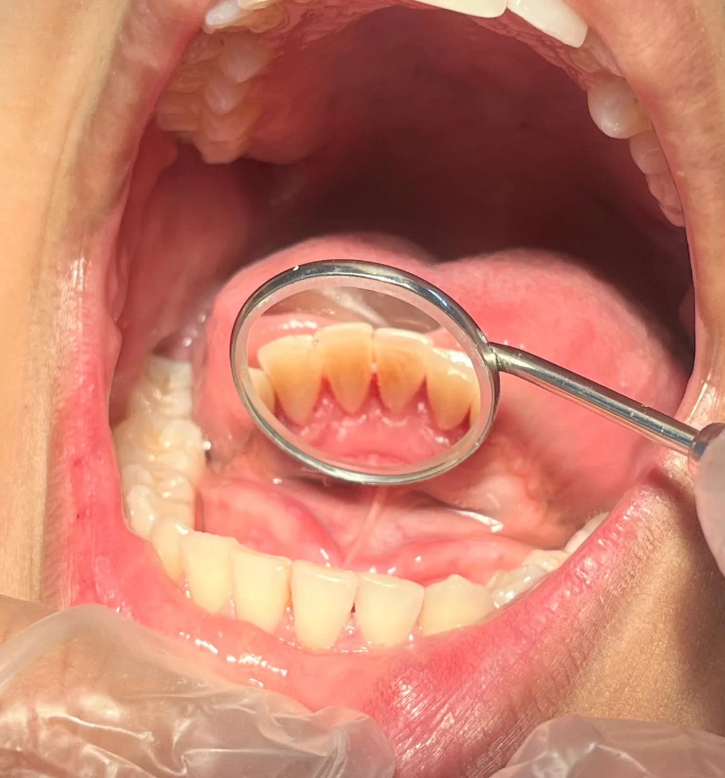 Avaliação da região interna dos dentes inferiores com espelho odontológico