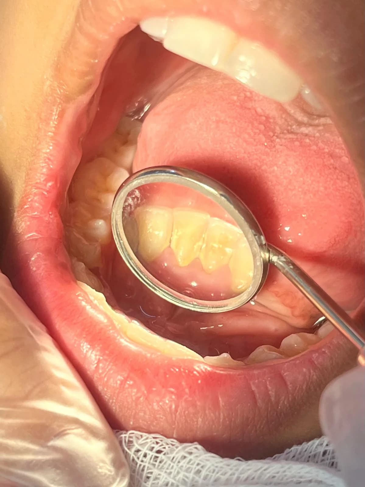 Registro clínico da região interna dos dentes inferiores
