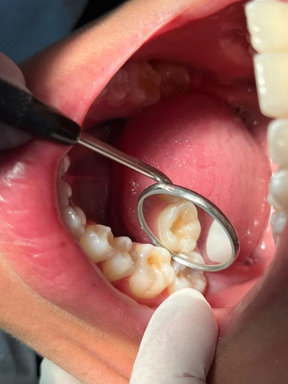 Avaliação clínica de dente posterior para restauração