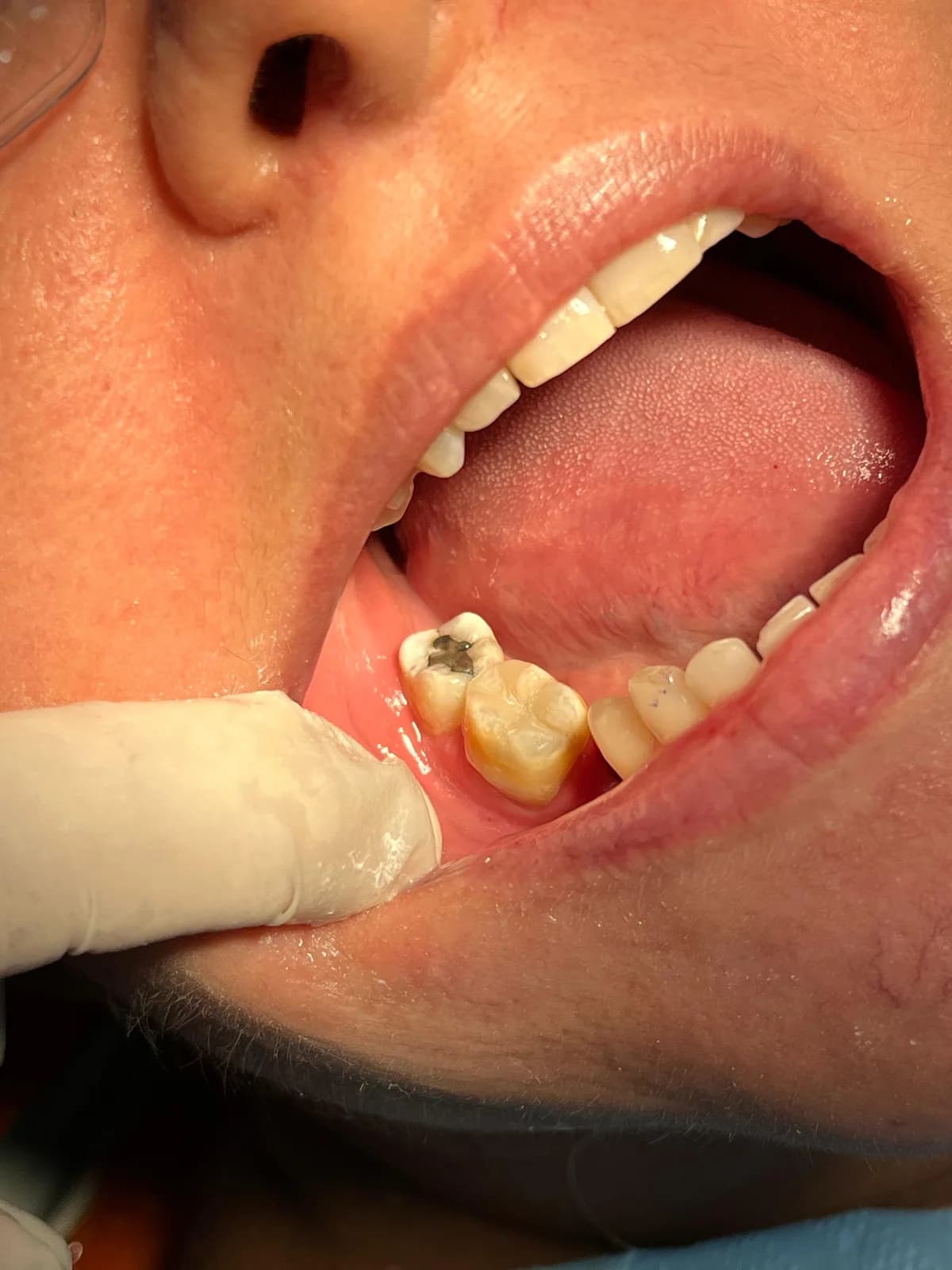 Registro intraoral de caso restaurador em dente posterior