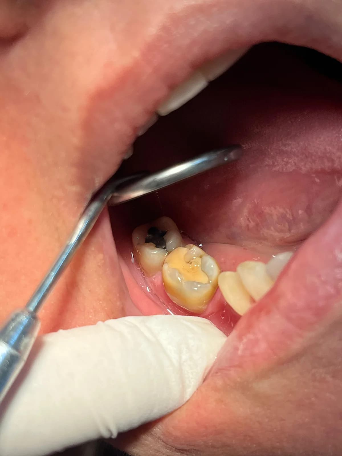 Detalhe clínico de restauração em dente posterior