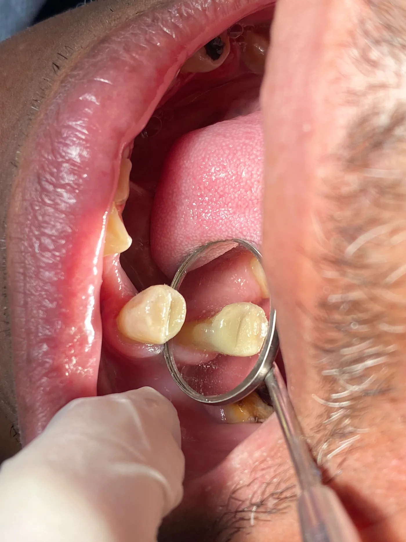 Resultado clínico após restauração Classe II em dente posterior